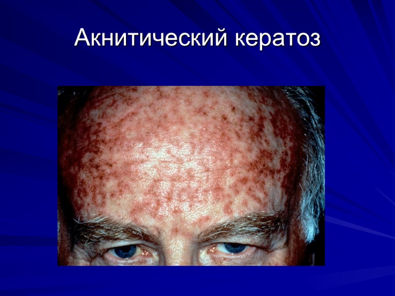 Акнитический кератоз